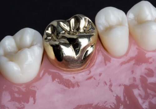 Restorative-Dentistry-Crowns
