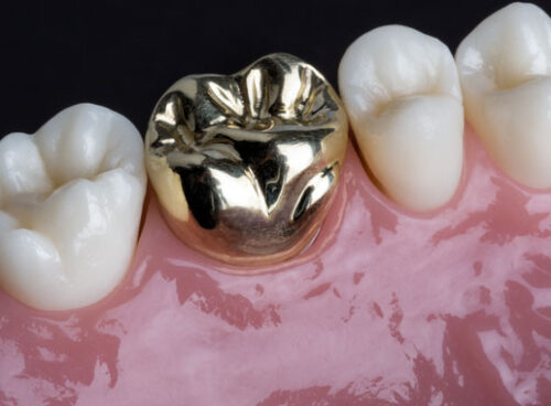 Restorative-Dentistry-Crowns