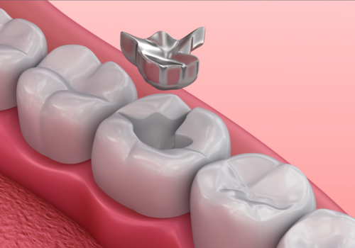 amalgam filling