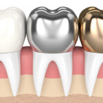 3d render of teeth with gold
