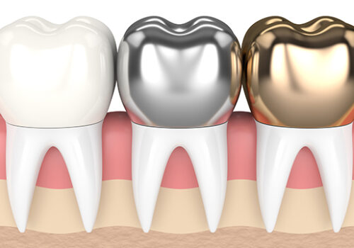 3d render of teeth with gold