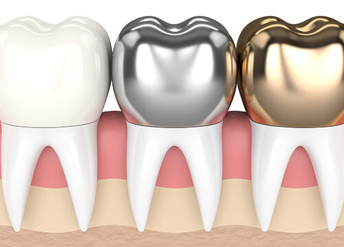 3d render of teeth with gold