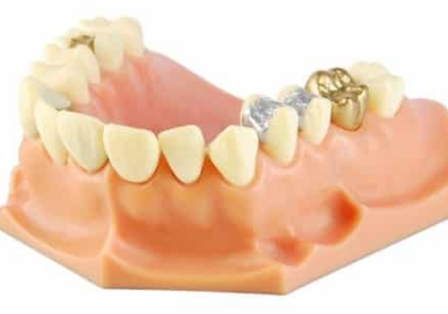 dental filling