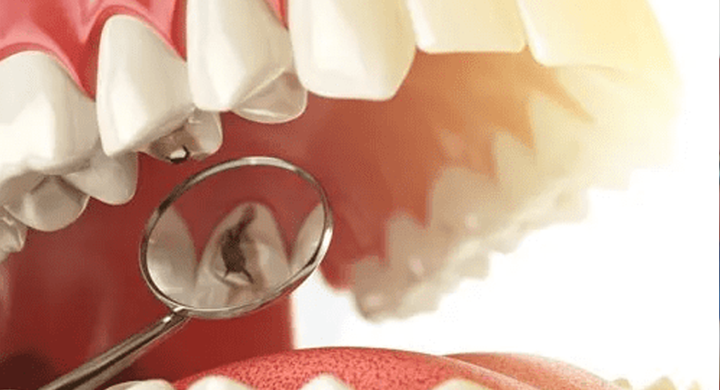 What Are Toxic Dental Materials? Fillings, Braces, & More! UDENZ