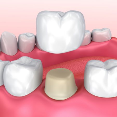 zirconia crown