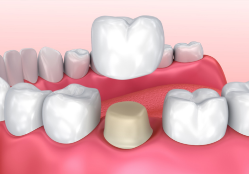 zirconia crown