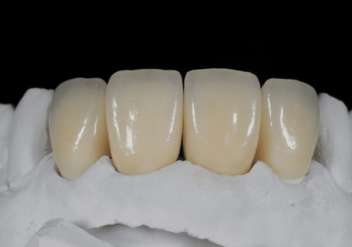 zirconia crown