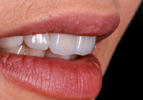 zirconia crown
