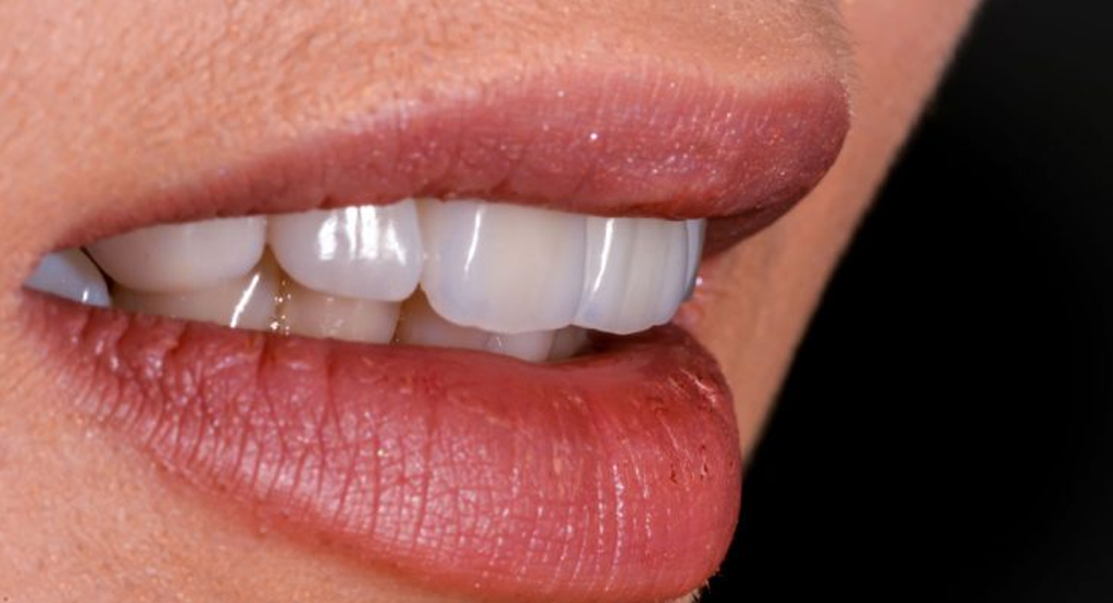 How Long Do Zirconia Crowns Last? UDENZ MENA DENTAL PLATFORM