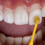 What Are Porcelain Dental Veneers?