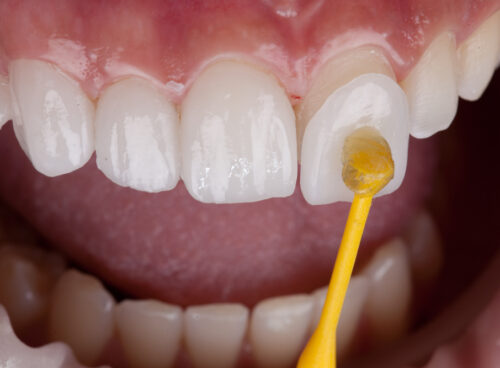 What Are Porcelain Dental Veneers?