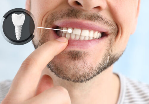 Dental Implants