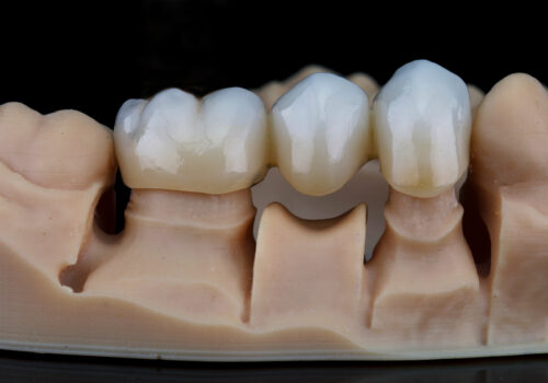 What Is A Dental Bridge?