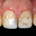 Soft teeth (Enamel fluorosis)