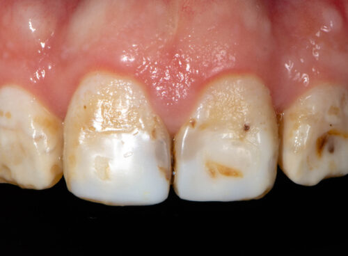 Soft teeth (Enamel fluorosis)