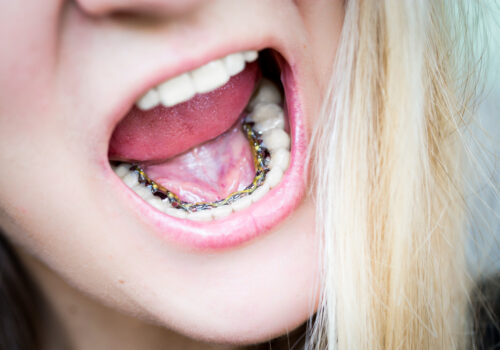 What Are Lingual Braces?