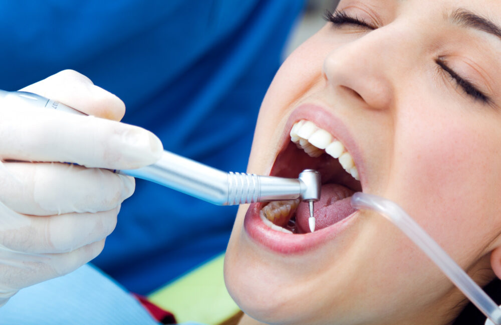 Can Teeth Be Whitened After a Root Canal?