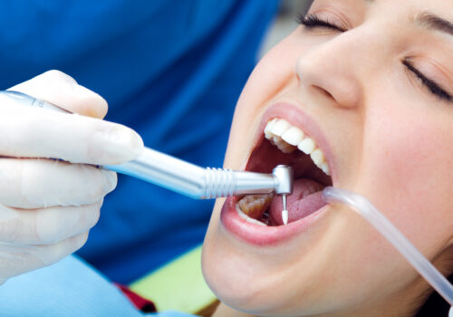 Can Teeth Be Whitened After a Root Canal?