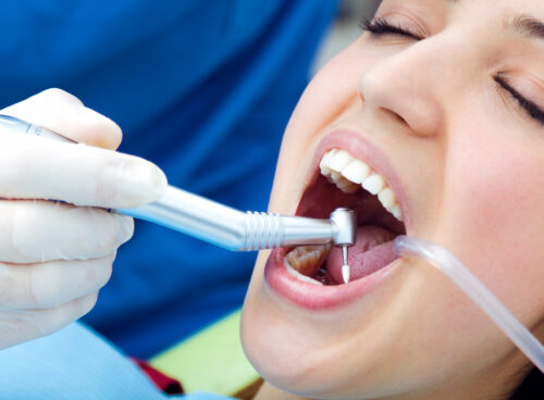 Can Teeth Be Whitened After a Root Canal?