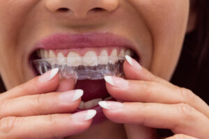 Wearing and Caring for Invisalign Aligners