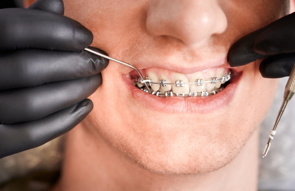 Everything You Need to Know About orthodontic treatment