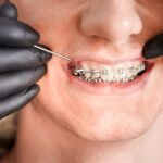 Everything You Need to Know About orthodontic treatment