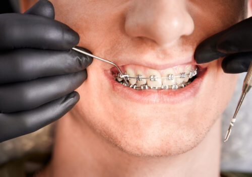 Everything You Need to Know About orthodontic treatment