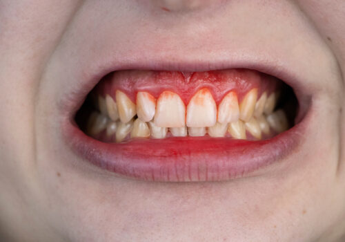 7 Causes of Bleeding Gums