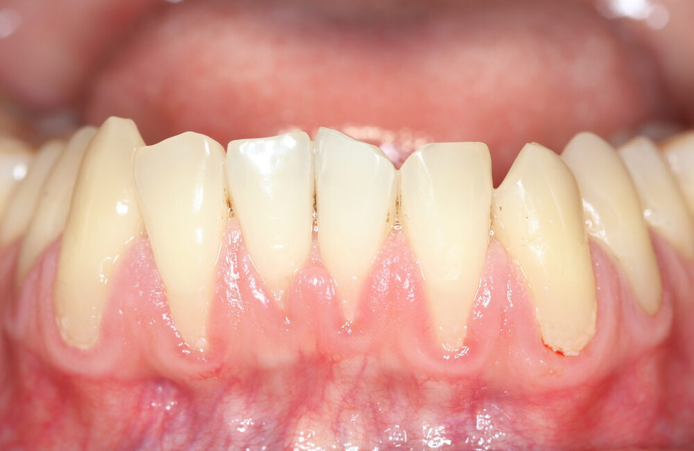 Gum Recession - Causes, Symptoms, Treatment, and Prevention