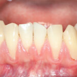 Gum Recession - Causes, Symptoms, Treatment, and Prevention
