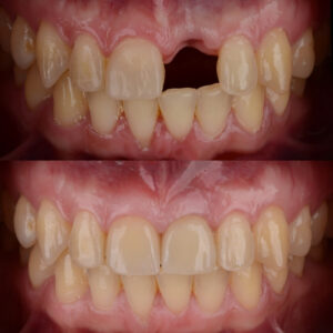 What steps are involved in getting dental implants?