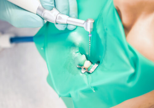How Root Canal Treatment Can Treat an Infected Tooth?