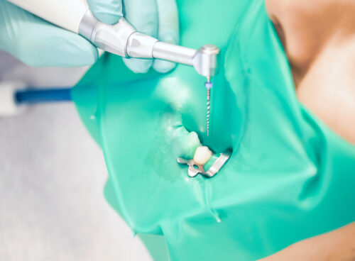 How Root Canal Treatment Can Treat an Infected Tooth?
