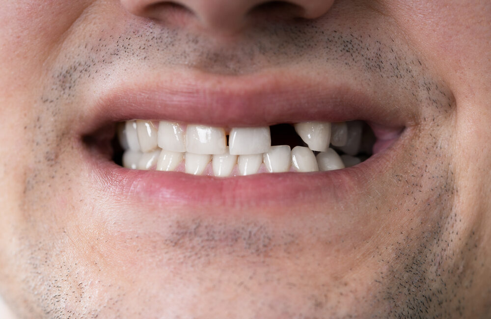 5 Reasons to Replace Missing Teeth
