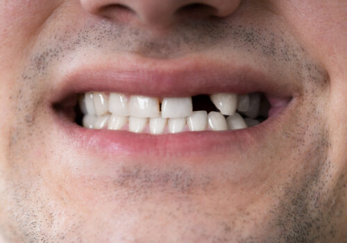 5 Reasons to Replace Missing Teeth