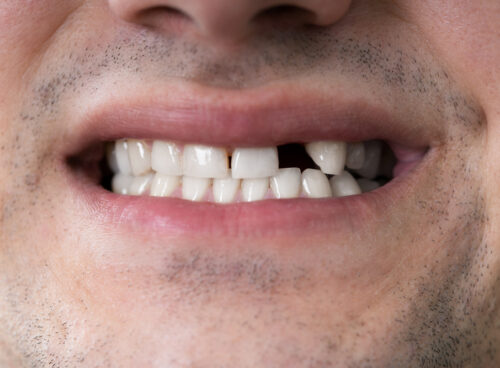 5 Reasons to Replace Missing Teeth