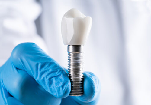 What is The Dental Implant?