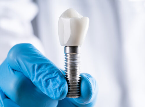 What is The Dental Implant?
