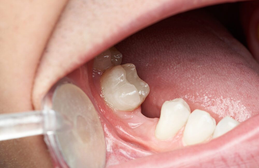 Do I Have to Replace My Extracted Tooth?