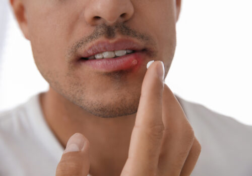 Types of Treatment for Mouth Ulcers