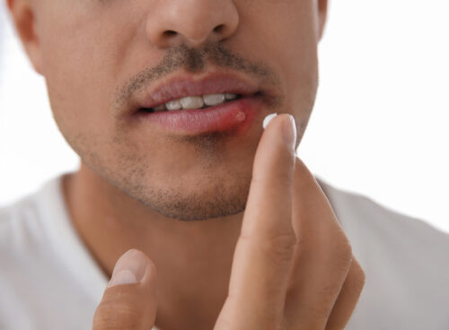 Types of Treatment for Mouth Ulcers