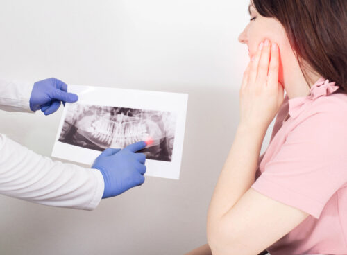Wisdom Teeth Removal: When Do They Need To Be Extracted?
