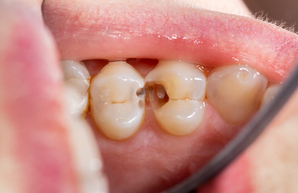Risk factors of Cavities