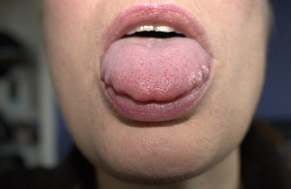 Scalloped Tongue: Causes and Treatment