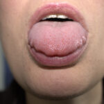 Scalloped Tongue: Causes and Treatment