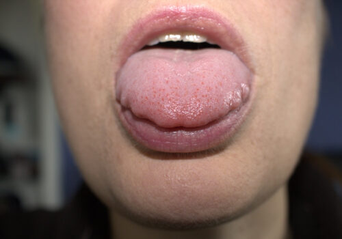 Scalloped Tongue: Causes and Treatment