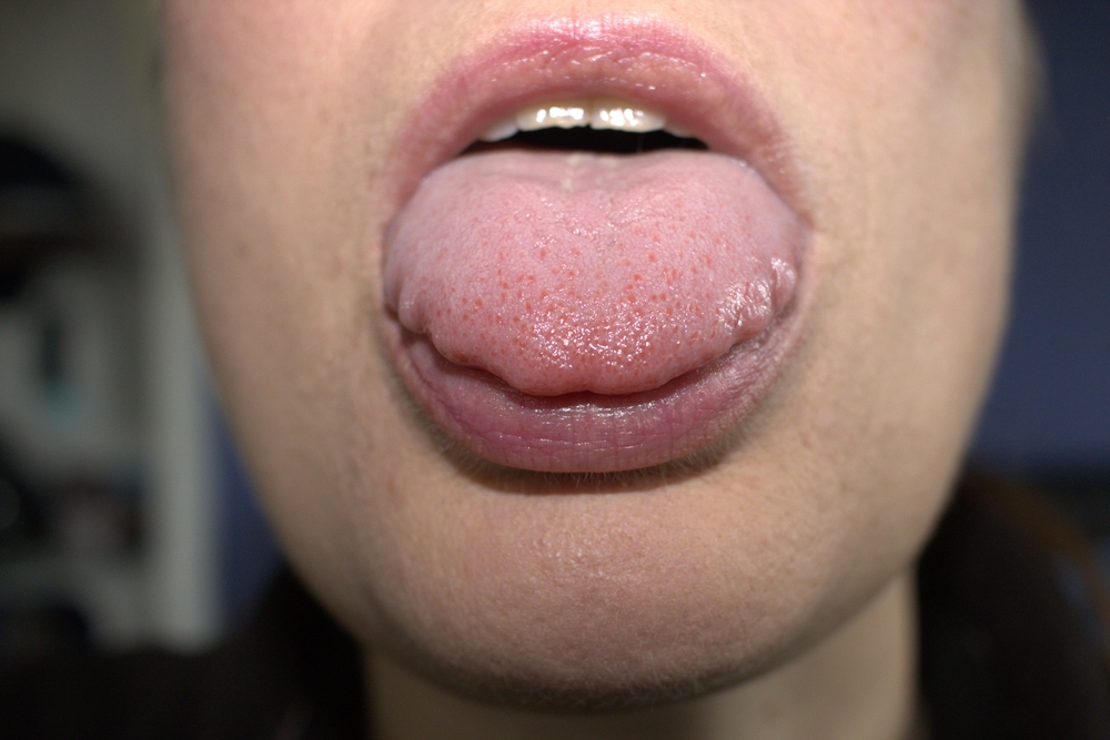 scalloped-tongue-causes-and-treatment-udenz-mena-dental-platform