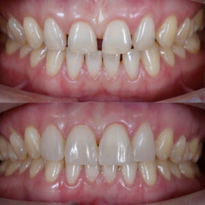 Composite Veneers