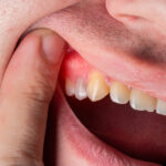 10 Home Remedies for a Tooth Abscess