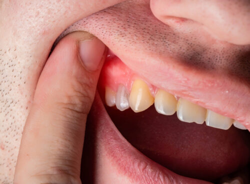 10 Home Remedies for a Tooth Abscess